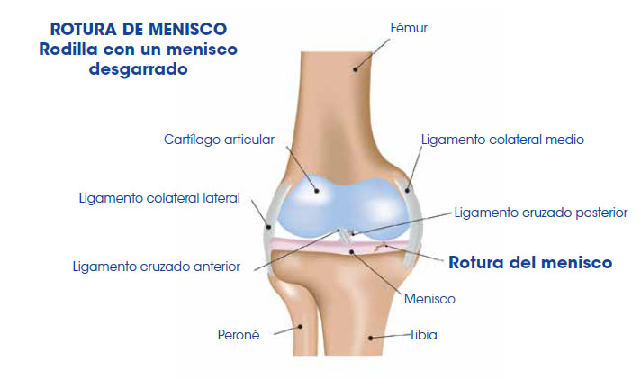 Ortosalud CR - Rodillera para Menisco: El menisco es una estructura  bastante resistente y elástica y las lesiones suelen darse de forma  traumática de la rodilla. Este fibrocartílago se vuelve más débil